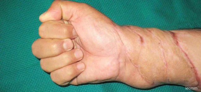 Doku Nakli: Deri Grefti, Serbest Flep ve İyileşme Süreci