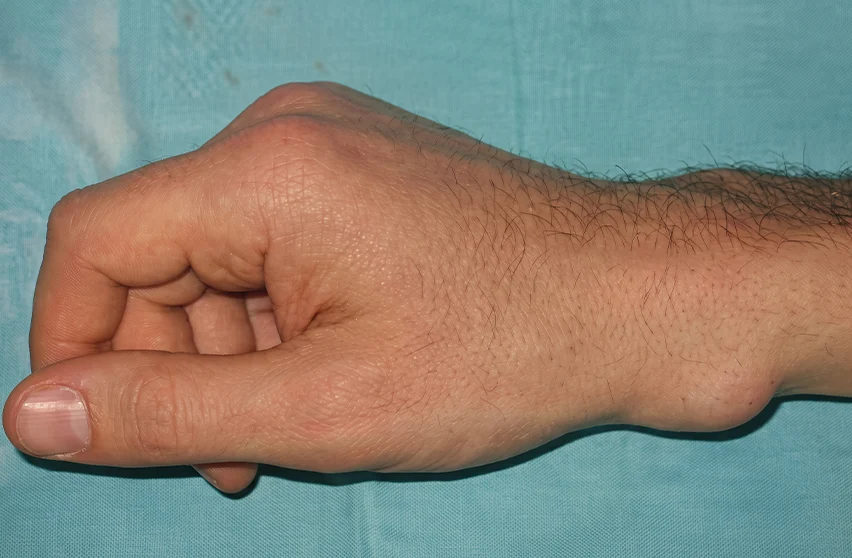 Ganglion Kisti