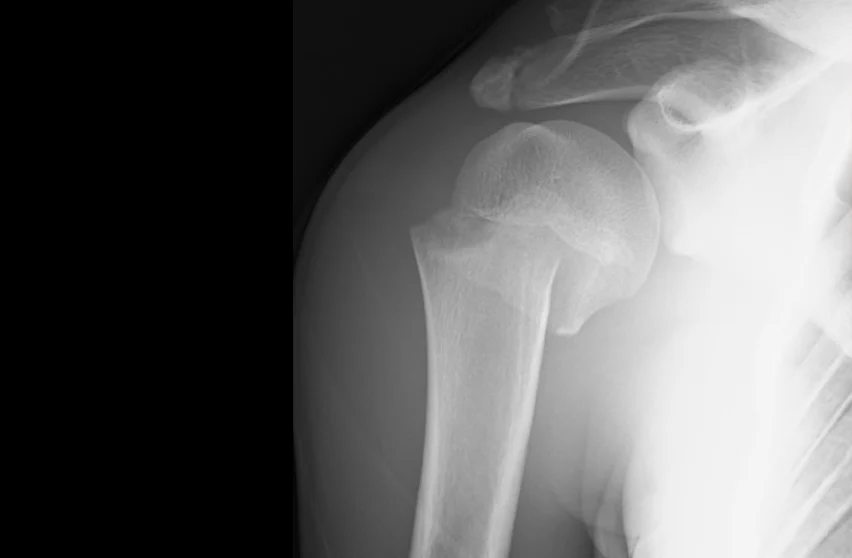 Proksimal Humerus Kırığı: Omuz Kırığı Belirtileri ve Tedavisi