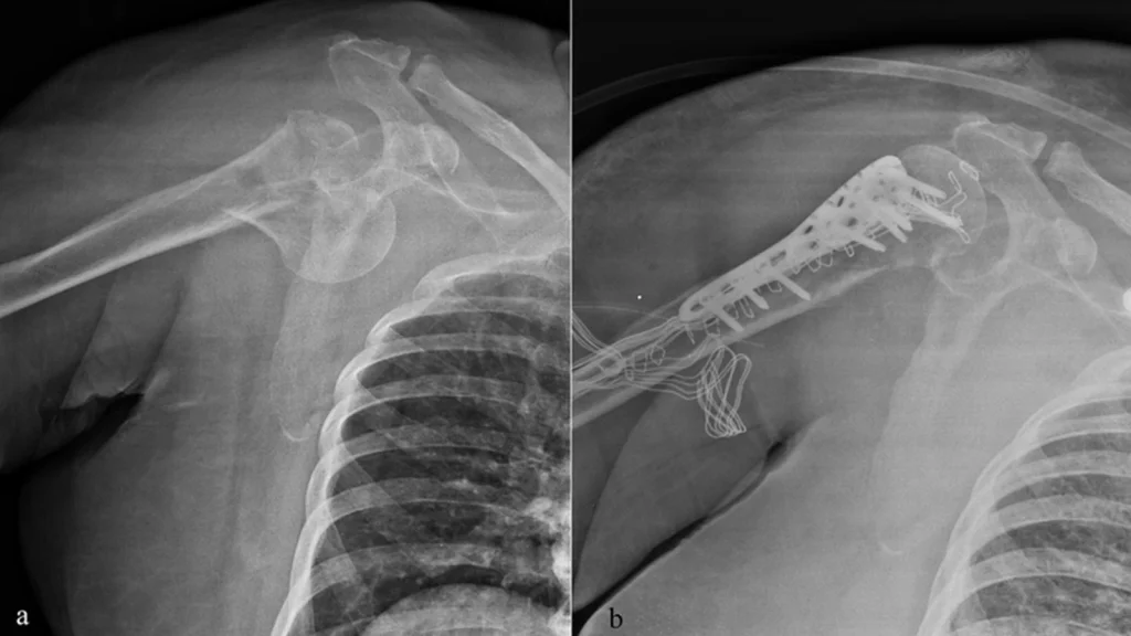 Proksimal Humerus Kırığı: Omuz Kırığı Belirtileri ve Tedavisi